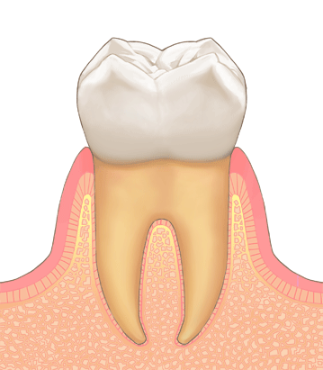 歯肉炎（軽度の歯周病の初期段階）